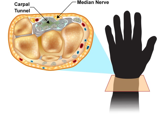 Carpal-Tunnel